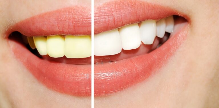 Teeth Whitening