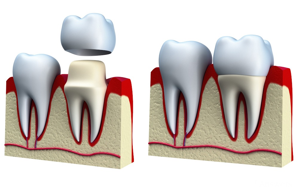 Custom Dental Crowns