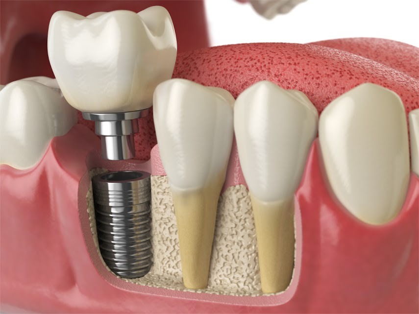 Single Tooth Implants