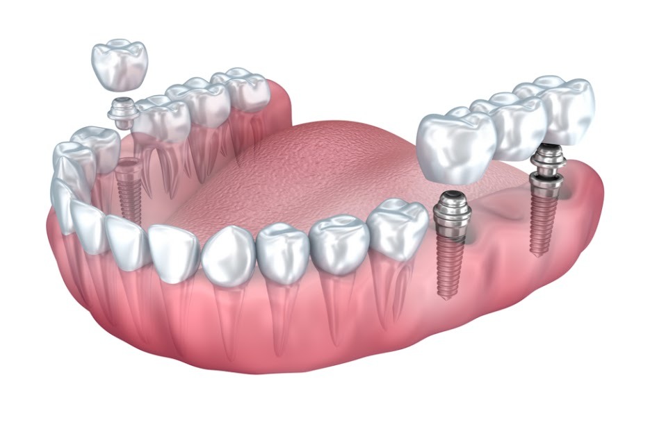 Full Arch Implants (All-on-4)