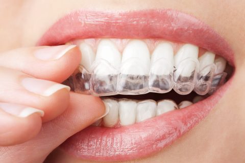 teeth with whitening tray